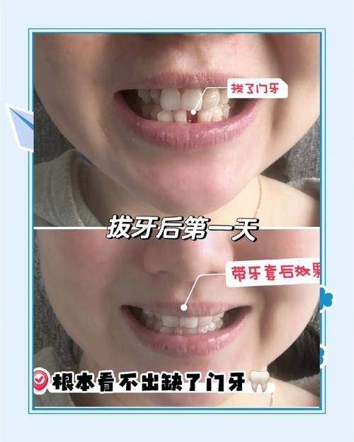 拔牙正畸牙缝合不上-图2