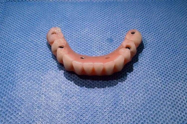 植牙后临时牙套-图1 植牙后临时牙套-图1