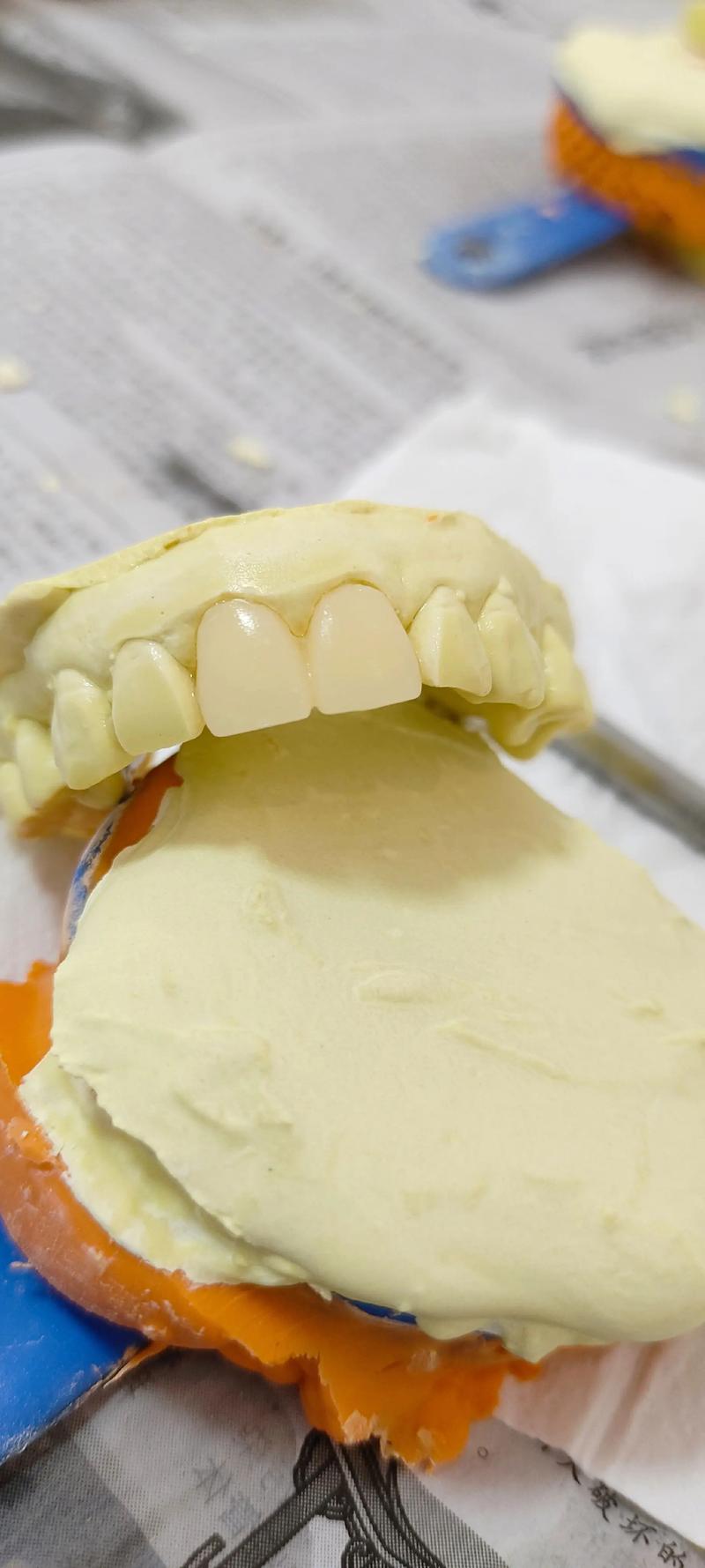 植牙后临时牙套-图3 植牙后临时牙套-图3