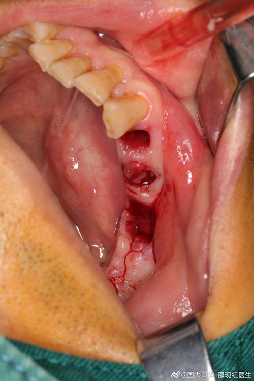 植牙植骨后头痛，是什么原因导致的？-图3