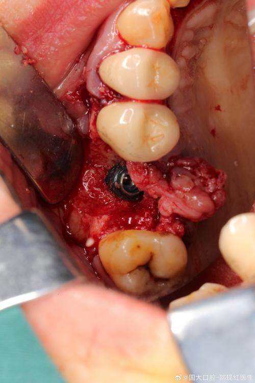 植牙植骨后血块-图1