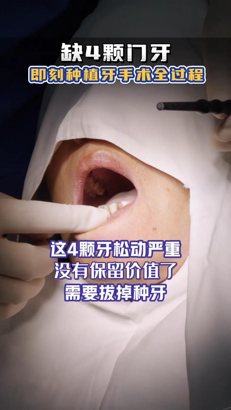 缺牙太久没处理，现在植牙还来得及吗？-图2