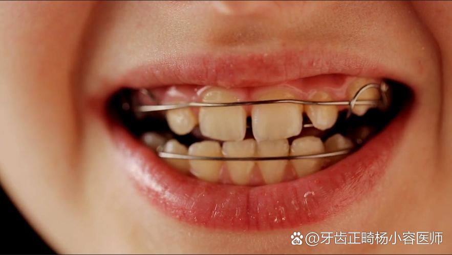 正畸矫正后牙齿松动，正常吗？需要处理吗？-图2