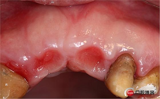 梁光强植牙法-图1 梁光强植牙法-图1