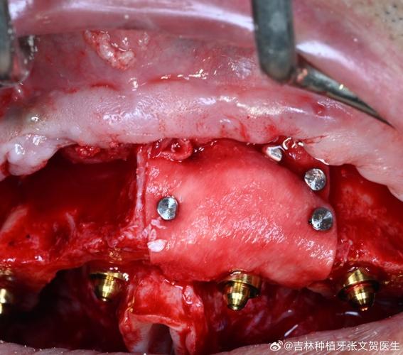 种牙植自己骨-图3 种牙植自己骨-图3