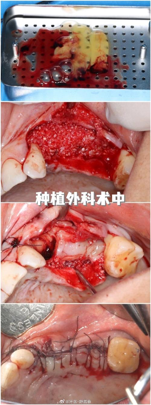 种牙植自己骨-图2 种牙植自己骨-图2