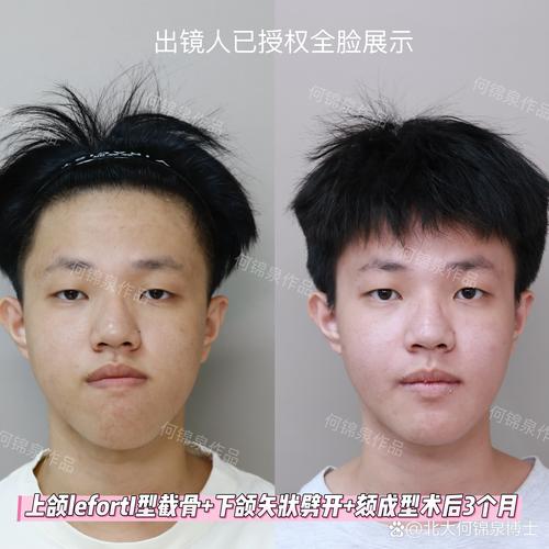 正颌术后正畸治疗一般需要多长时间？-图1