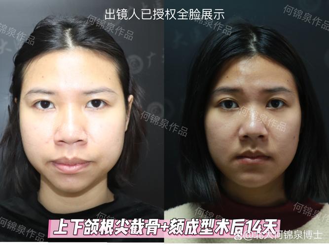 正颌术后正畸治疗一般需要多长时间？-图2