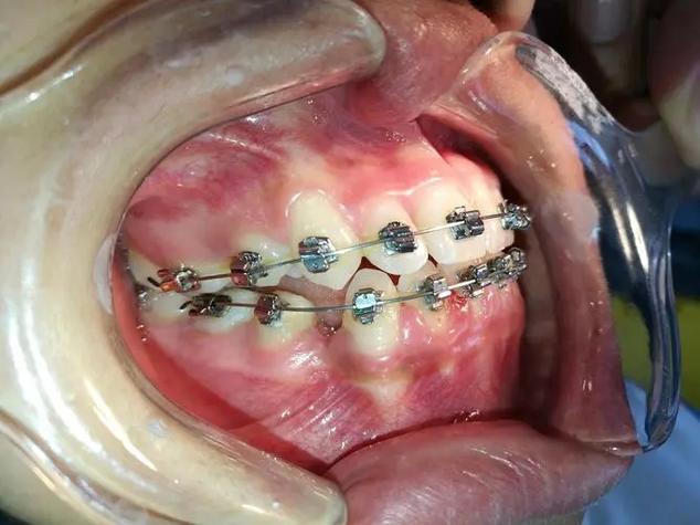 口腔直丝弓正畸视频-图2 口腔直丝弓正畸视频-图2