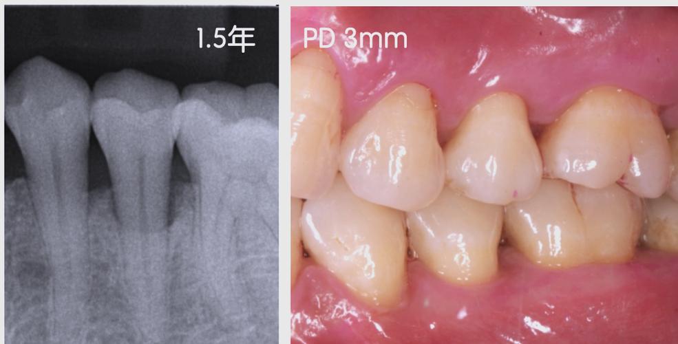 牙周手术植骨效果如何？恢复期需注意什么？多久能恢复正常？-图1