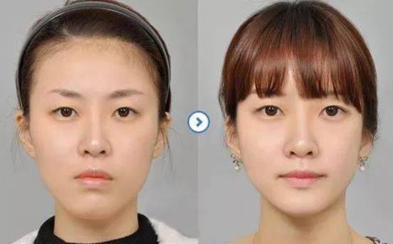 正畸拔牙后脸型变化-图2 正畸拔牙后脸型变化-图2