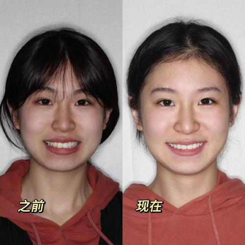正畸拔牙后脸型变化-图3 正畸拔牙后脸型变化-图3