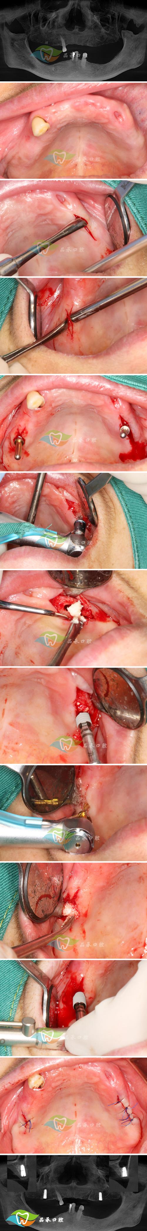 正畸 骨皮质切开术-图1