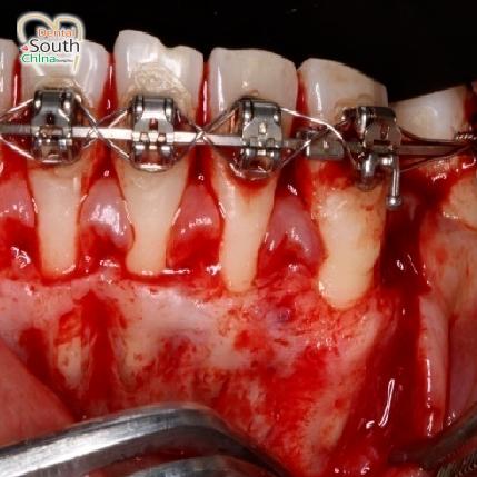 正畸 骨皮质切开术-图2