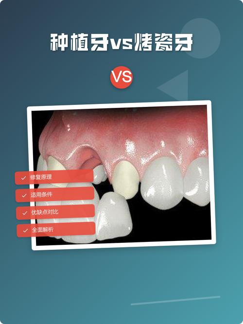 植牙和烤瓷牙，哪种更适合你的牙齿修复？-图1