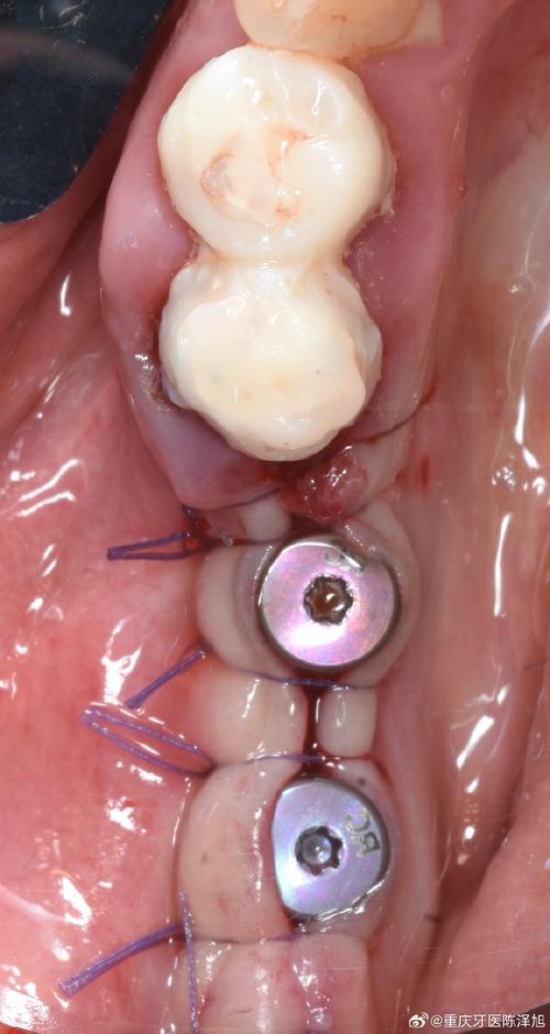 牙周炎 植牙-图3