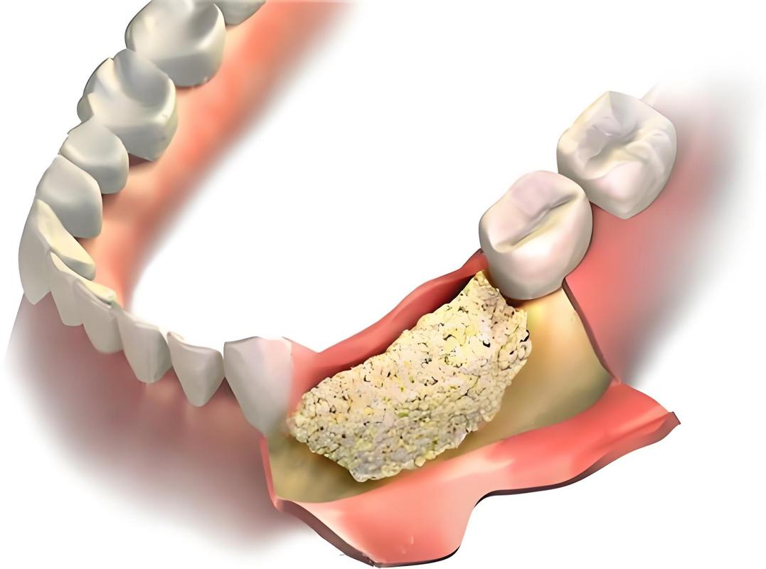自碎牙植骨效果如何？优势究竟在哪？-图3