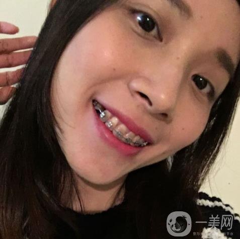 光华口腔医院 正畸-图2