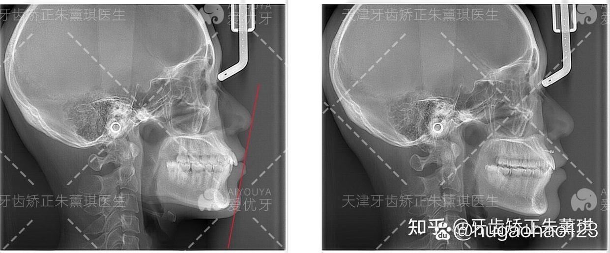 天津口腔医院 正畸-图1 天津口腔医院 正畸-图1