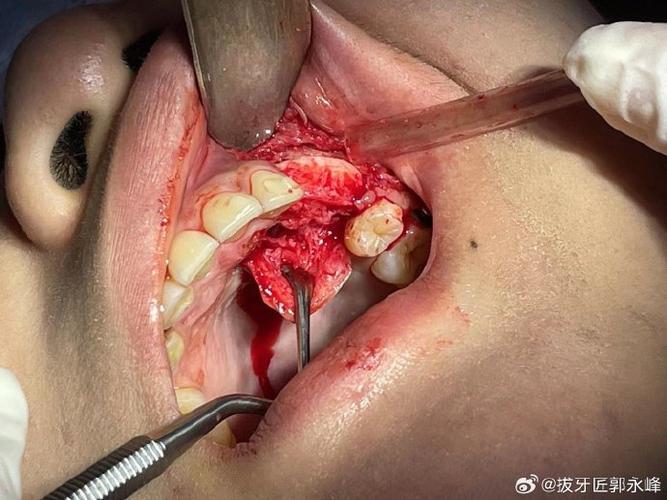 牙槽植骨哭-图1