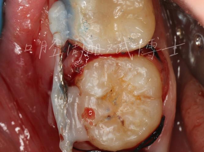 植牙自体股-图1