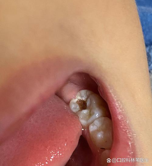 正畸智齿还没长出来-图2