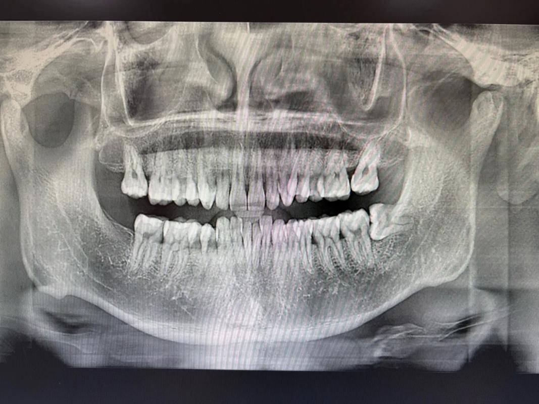 正畸智齿还没长出来-图3