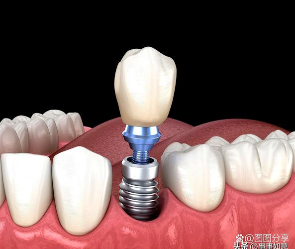 植牙跟牙套-图3 植牙跟牙套-图3