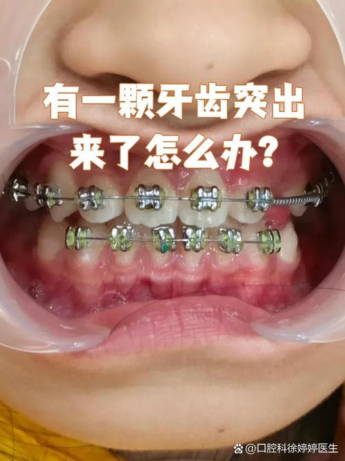 做正畸要注意的地方-图3