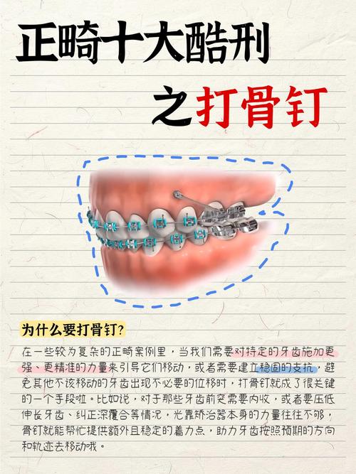 牙齿正畸打骨钉图片，过程疼不疼？效果怎么样？-图3