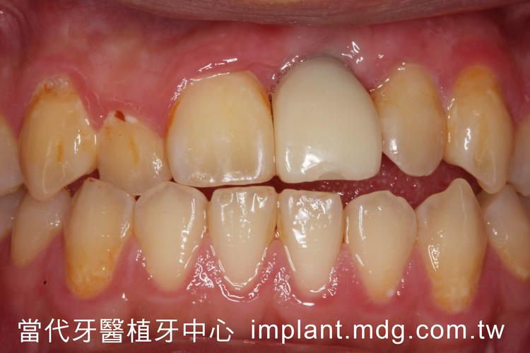 植牙手术后-图1