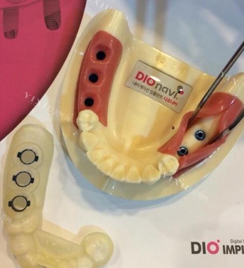 dio植牙-图1