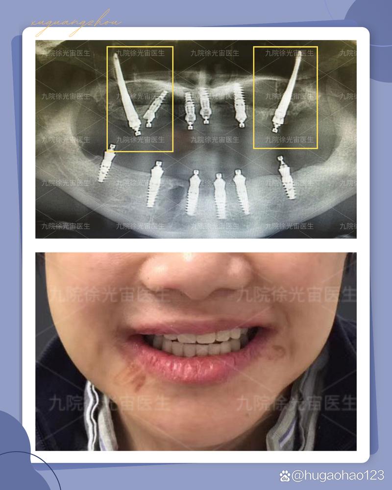 九院 植牙-图2
