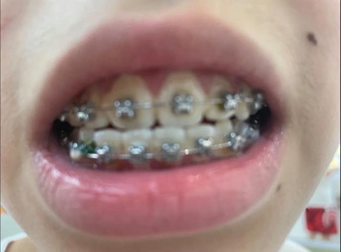 正畸打骨钉内收效果-图2