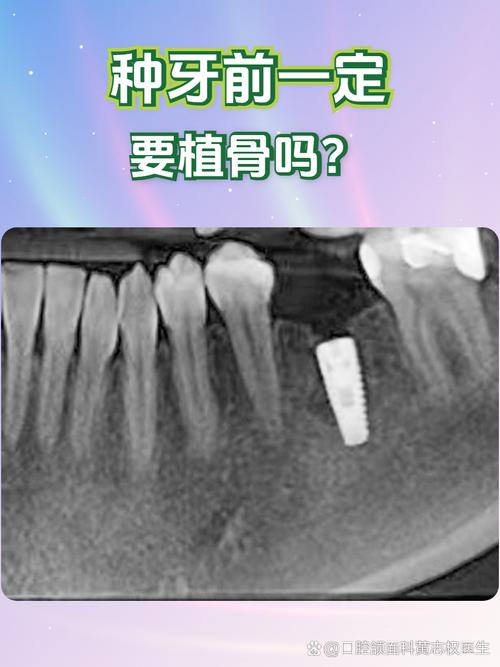 牙槽骨不足必须植骨吗?手术效果如何?-图1 牙槽骨不足必须植骨吗?手术效果如何?-图1