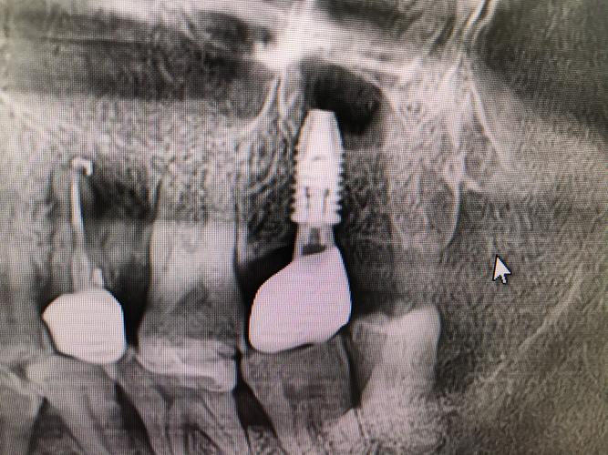 植牙数位照是什么？它如何提升植牙精准度？-图3