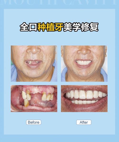 植牙效果图-图1 植牙效果图-图1