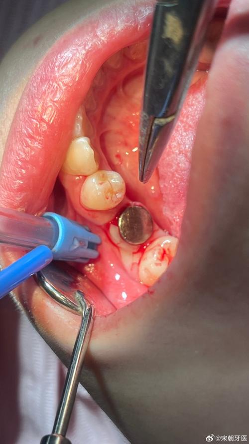 上门牙植牙-图3