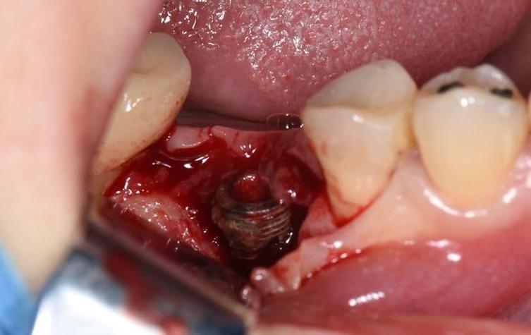 植牙后发炎-图1 植牙后发炎-图1