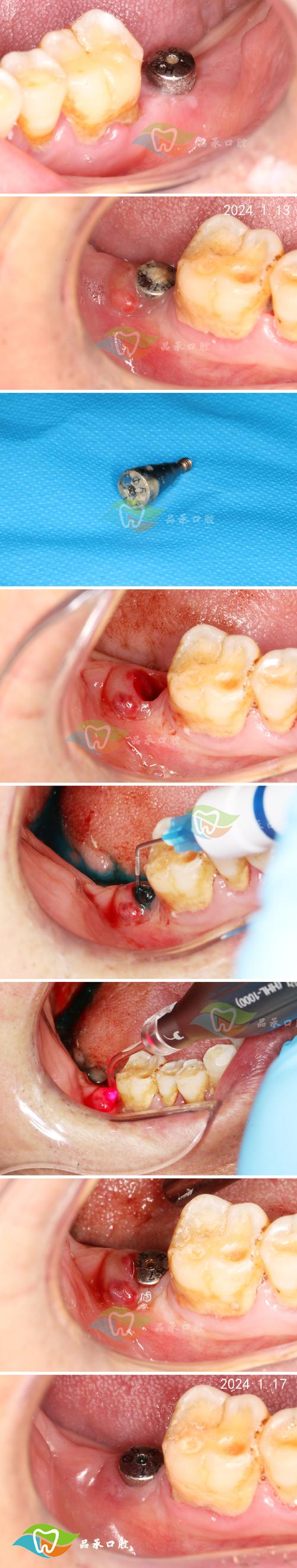 植牙后发炎-图2 植牙后发炎-图2