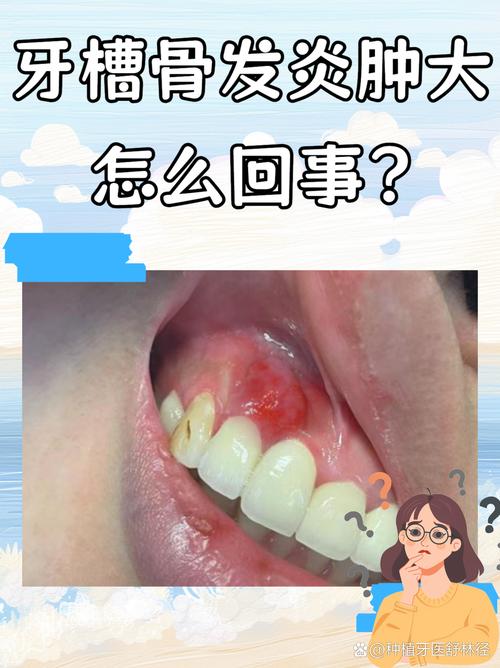 植牙后发炎-图3 植牙后发炎-图3