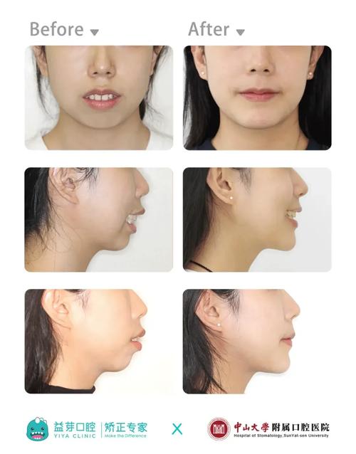 正畸四个月想正颌-图1