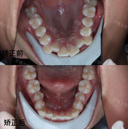 正畸四个月想正颌-图2