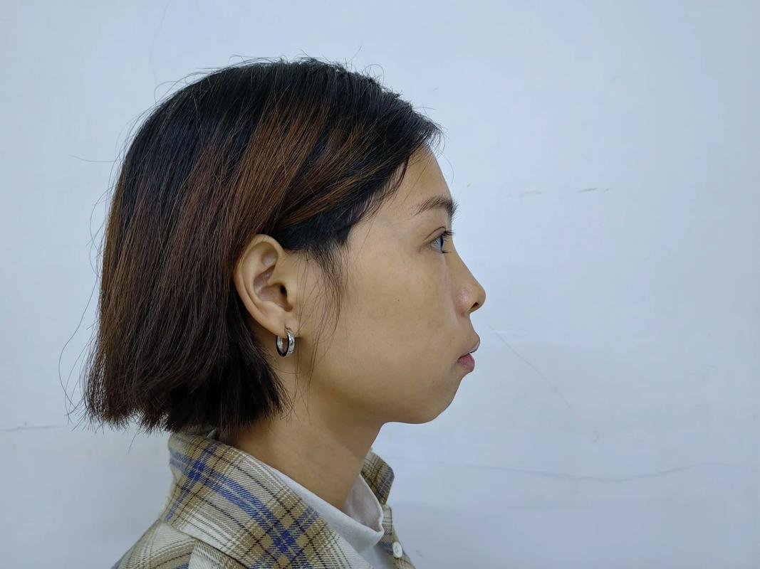 正畸四个月想正颌-图3