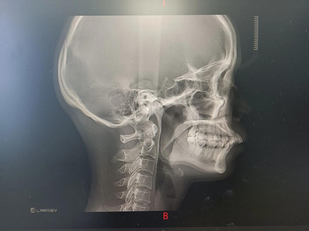 正畸三个月的片子-图3
