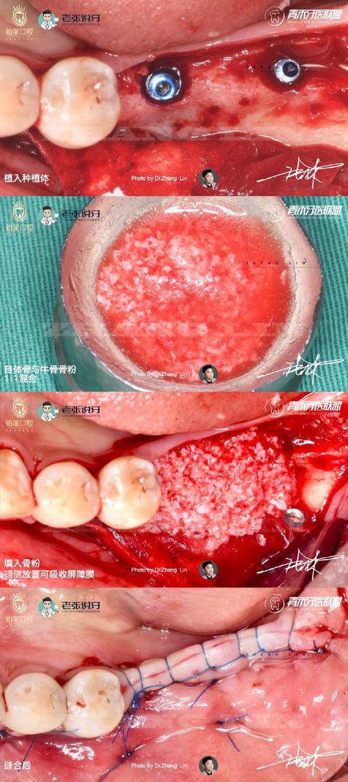 拔牙后植牙-图2 拔牙后植牙-图2