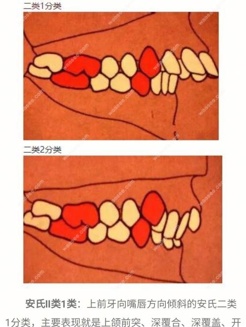 正畸安氏三类分型-图2