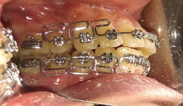 正畸弓丝往一边跑-图1