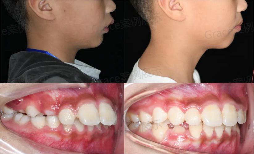 骨性错颌二类正畸-图2