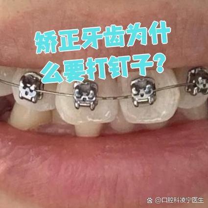 正畸种植钉掉了一点需要处理吗？-图2